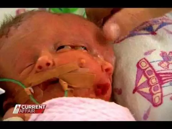 See The Baby Born With 1 Head And 2 Faces In Australia (Photos)
